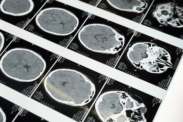 image of a brain scan